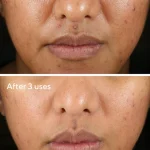 Rapid relief acne spot treatment / tratamiento facial de murad