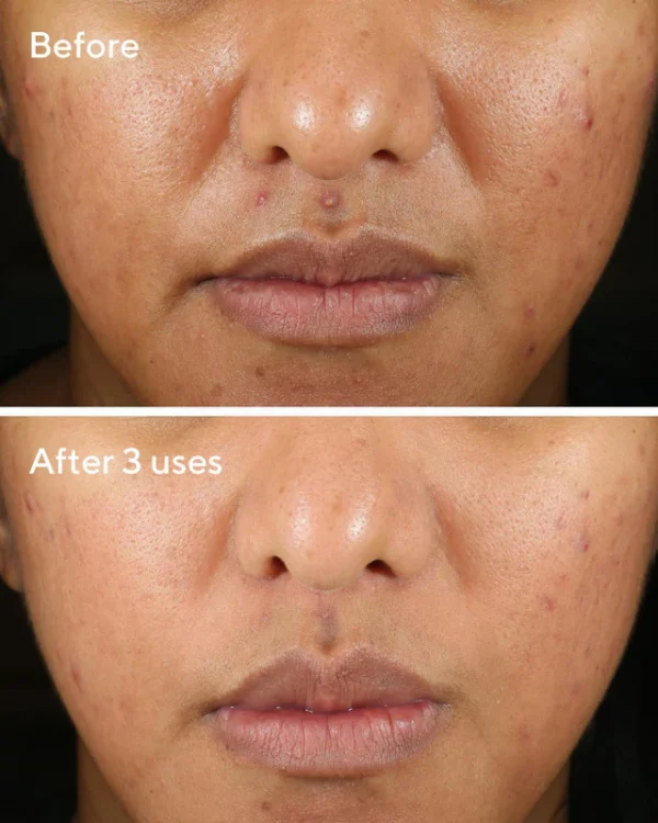 Rapid relief acne spot treatment / tratamiento facial de murad