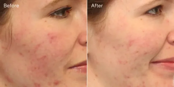 Acne Control Clarifying Cleanser